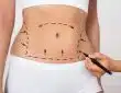 la liposuccion